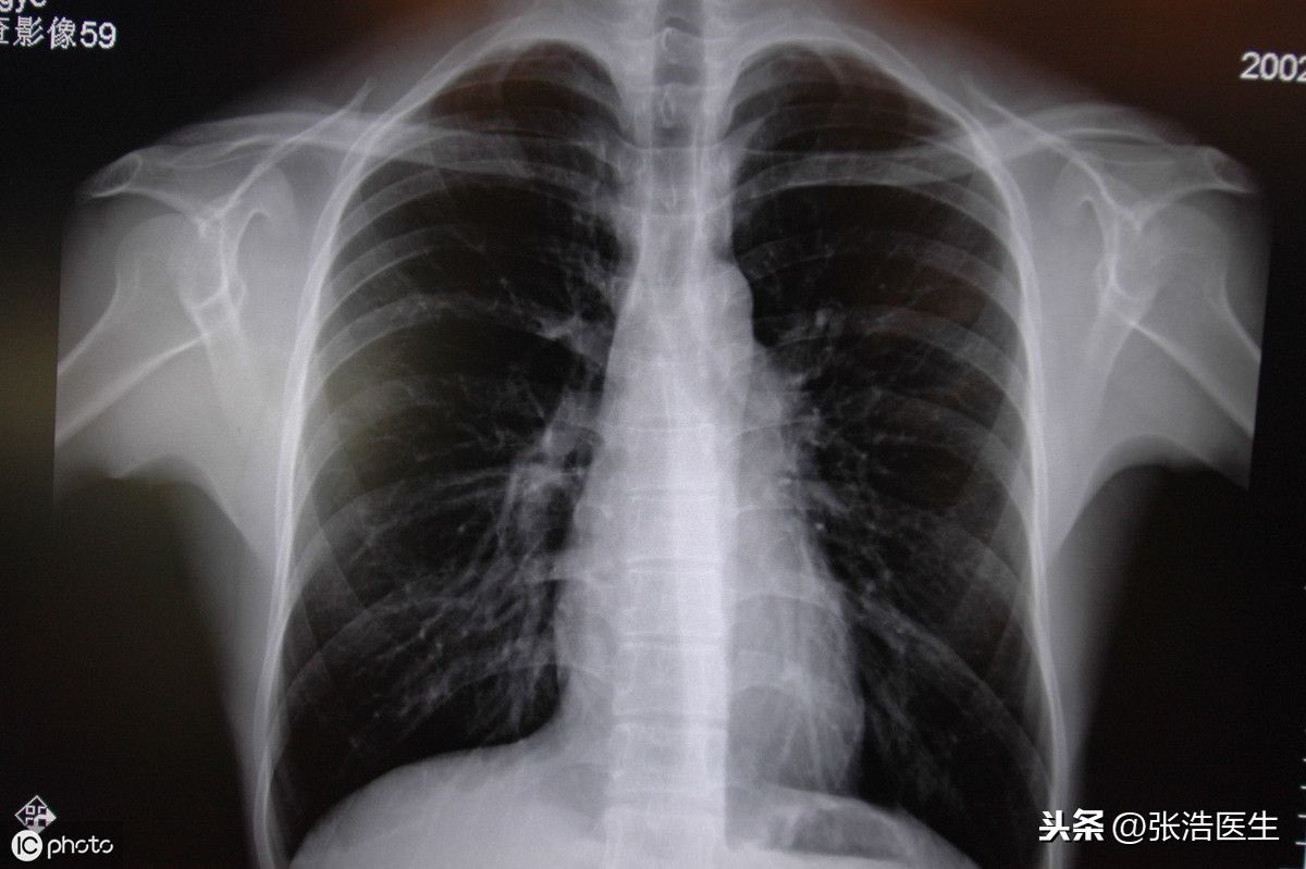 右侧后背疼痛是什么原因？会不会是肺部肿瘤？